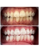 エクシアホワイトニング 日本橋店/美白/人形町ホワイトニング