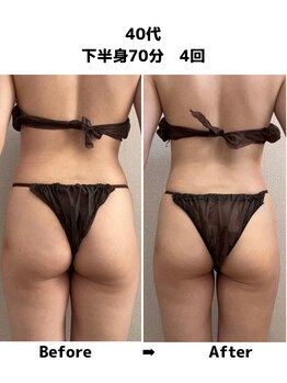 タノソイネ(tanosoine)/【40代/ハイパーナイフ痩身】