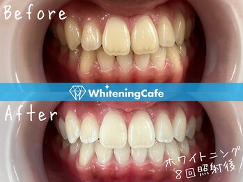 ホワイトニングカフェ 葛西店(WhiteningCafe)/☆ホワイトニング8回症例☆