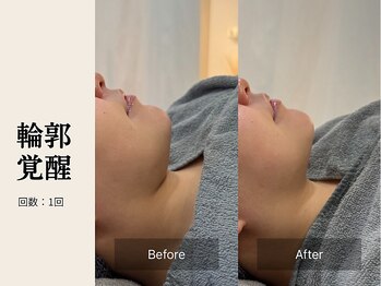 サロン ルイス アディクト(salon Lewis Addict)/小顔リフト
