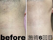 ニコ アンド キャンディー(Nico.&Candy)/ヒゲ脱毛