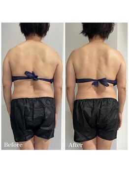 クリア(CLEAR)/綺麗な背中作り