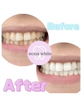 エクシアホワイトニング エミフルMASAKI店/ビフォーアフター