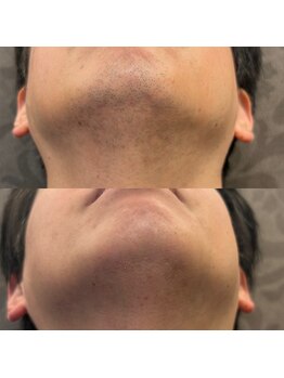 フェリーバ 流山店(FELIVA)/顎下のお髭、お任せ下さい(^^)