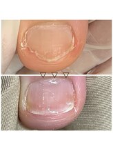 リネイル 長浜(Re-na-iL)/ネイルケア＆スパ¥7000