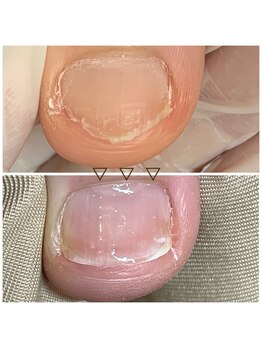 リネイル 長浜(Re-na-iL)/ネイルケア＆スパ¥7000