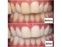 キングスサロン 神戸ハーバーランド店の雰囲気（しみることなく、簡単・短時間で理想の白い歯を目指せます♪）