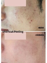 ボヌール バイ ユニ(bonHeuR by uni.)/ILLONショートカットピーリング