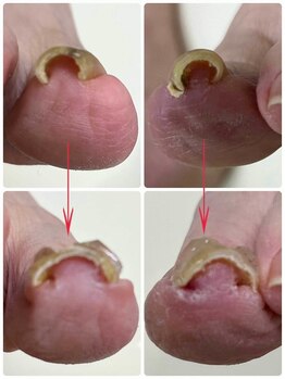 名古屋駅前巻き爪センター/巻き爪