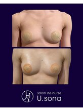 小顔・脂肪コントロール専門 salon de nurse U.sona～松本店～/【バストケア】脂肪増殖10cc