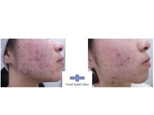 フェイシャルスタイリストサロン 高崎店(Facial Stylist Salon)/ケア例（88）