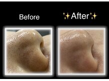 エムドット(M.)/毛穴洗浄★ハイドロフェイシャル