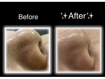 エムドット(M.)/毛穴洗浄★ハイドロフェイシャル