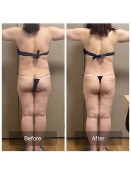 カーロ(CARO)/痩身BA★上半身5回/尻2回