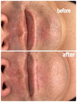 アモ(amo)/髭脱毛ビフォーアフター