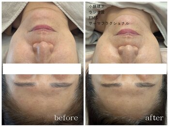 メゾンリュバン 梅田店(Maison Ruban)/小顔矯正・EMS・サーマ