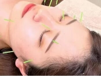 マーサ鍼灸接骨院 イオンタウン浜松葵院の写真/【美容鍼×小顔矯正】身体と美のプロによる信頼技術◎美肌/小顔/エイジングケアも叶う◎『鍼』初体験歓迎！