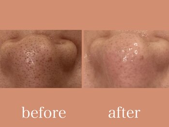 エピラックス(epilax)/ハイドラフェイシャル