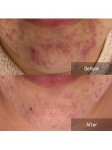 ラヴニール(L'avenir)/思春期ニキビや炎症ニキビのケア