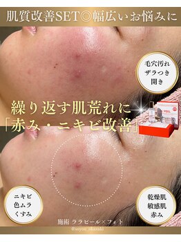 ソユ(SOYOU)/施術* ララピール×フォト