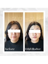 フローフシ∞/【小顔】40代女性症例写真