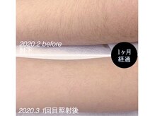 グリシーヌ(GLYCINE)/脱毛効果★