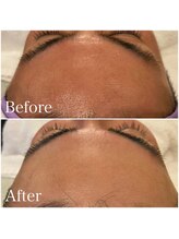 ロリー(LOLiE)/メンズフェイシャルwax