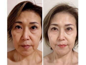 巡りサロン結希(ゆき)/Umi化粧品1ヶ月