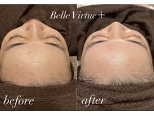 ベルバーチュプラス(Belle Virtue +)/カーボキシー