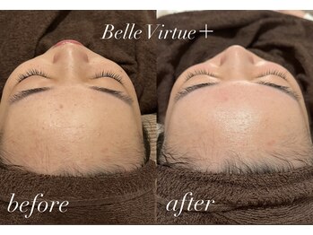 ベルバーチュプラス(Belle Virtue +)/カーボキシー