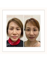 ソワン(soin)/小顔整顔×美肌ピーリング