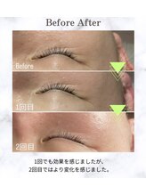 イードット(E.)/目尻のシワが気になる方に♪