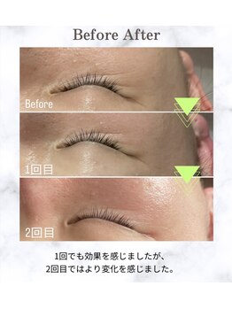 イードット(E.)/目尻のシワが気になる方に♪