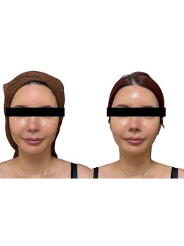 リノン(LIINON)/切らない。入れない。でも叶う