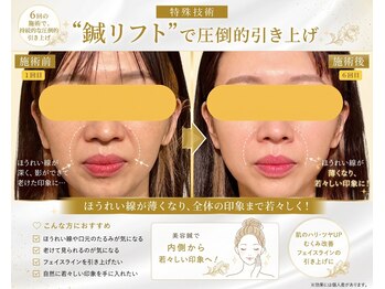 ビーネ 札幌琴似/ハリスリム 札幌琴似(Beene/Hari-Slim)/鍼リフトで引き上げ