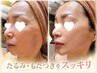 40代からのたるみ改善|ほうれい線・もたつき顔を引き締めるプラズマコース☆