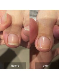 【ボコボコ爪がお悩み】のお客様