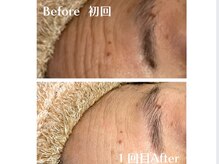 ヒーリングハーツ(Healing Hearts)/驚愕！シワ/肌くすみ改善！