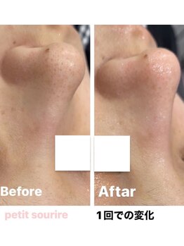 プティットスリール エステティック 栄本店(Petit Sourire Esthetic)/毛穴洗浄も人気です♪