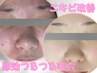 【フォト&ニキビケア】IPL光フォト（ニキビ改善）+ソフトピーリング+毛穴洗浄