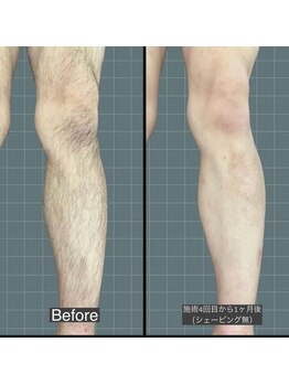 アレッド 大阪店(ared.)/脚脱毛