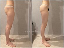 1台5役の最強痩身マシンでダイエット♪たった1回でもこの結果！