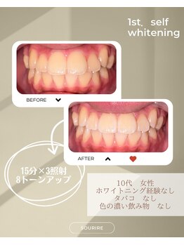 スリール(sourire)/ビフォーアフター