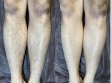 リエラ(Liella)/【足脱毛】