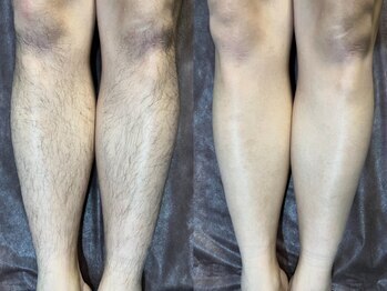 リエラ(Liella)/【足脱毛】