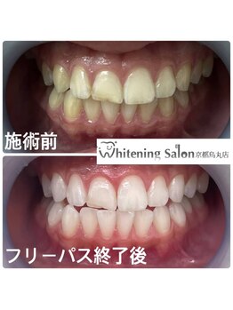 ホワイトニングサロン 京都烏丸店/ホワイトニング施術例