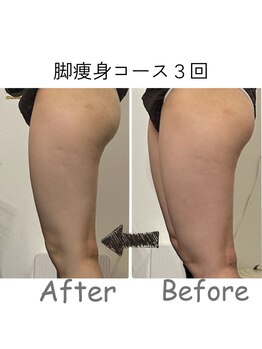 ナニワ ビューティー(naniwa beauty)/脚WINBACK痩身