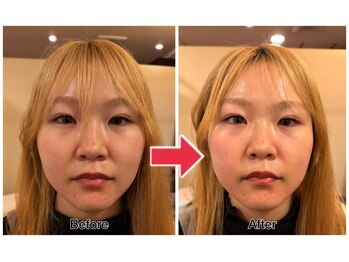 はやしだ鍼灸整骨院/美容鍼【顔のむくみ,肌荒れ】