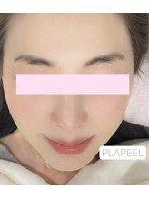 ドルチェナッツ ネオ 府内店(dolce nuts NEO)/プラピール＋新世代ヒーライト♪