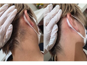 ウル バイ ラシック(Ulu by Lasic)/【うなじ脱毛】